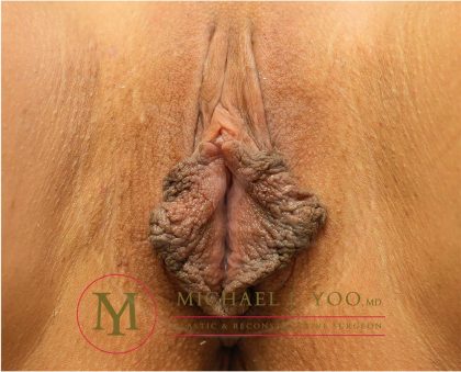 Labiaplasty Before & After Patient #3691