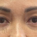 Lower Eyelid Lift Before & After Patient #3694