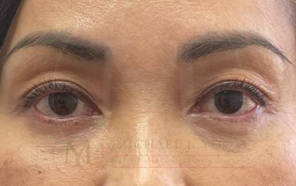 Lower Eyelid Lift Before & After Patient #3694