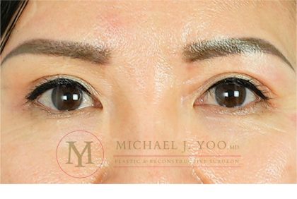 Upper Eyelid Lift Before & After Patient #3712