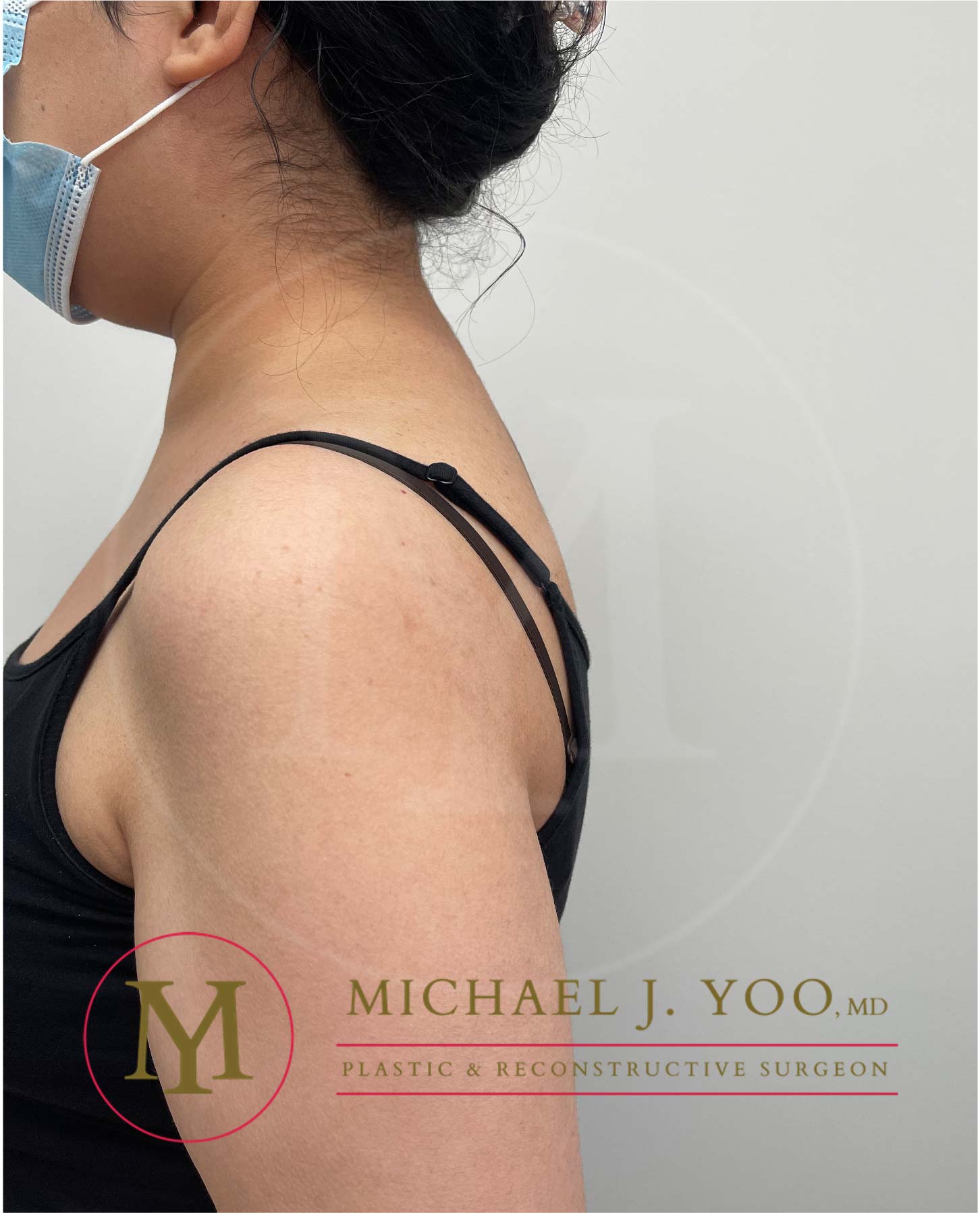 Buffalo Hump Liposuction Before & After Patient #3697