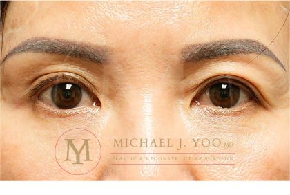 Upper Eyelid Lift Before & After Patient #3712