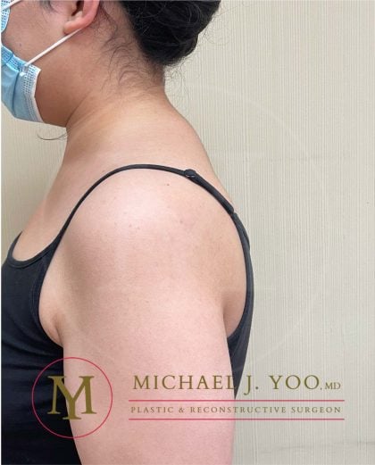 Buffalo Hump Liposuction Before & After Patient #3697