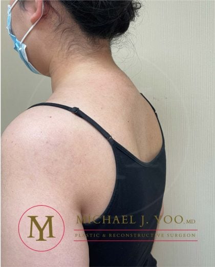 Buffalo Hump Liposuction Before & After Patient #3697