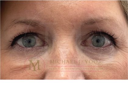 Upper Eyelid Lift Before & After Patient #3735