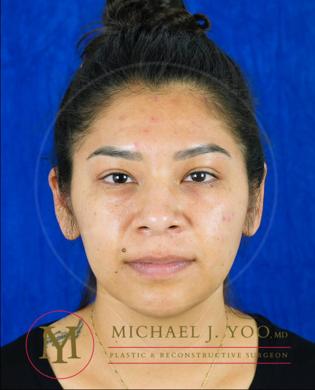 Otoplasty Before & After Patient #3790