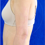 Arm Liposuction Before & After Patient #3765