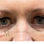 Upper Eyelid Lift Before & After Patient #3735