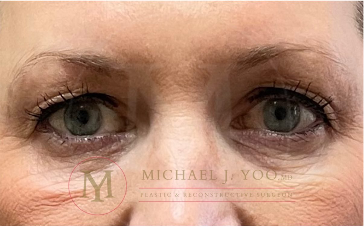 Upper Eyelid Lift Before & After Patient #3735