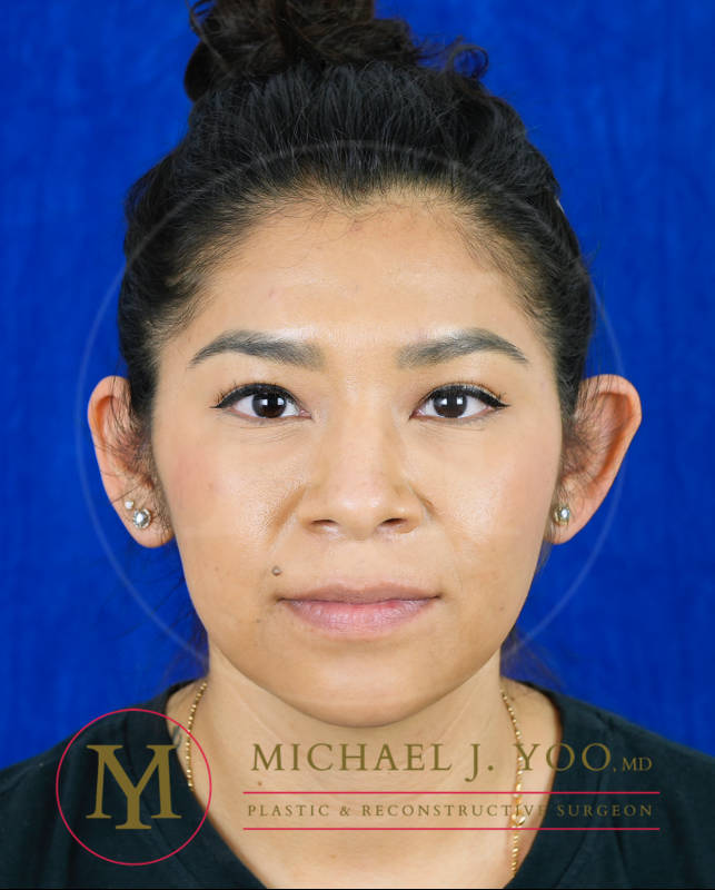 Otoplasty Before & After Patient #3790