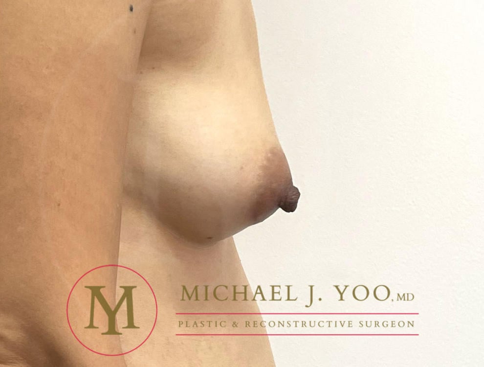 Nipple Reduction Before & After Patient #3838