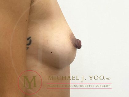 Nipple Reduction Before & After Patient #3829