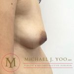 Nipple Reduction Before & After Patient #3838