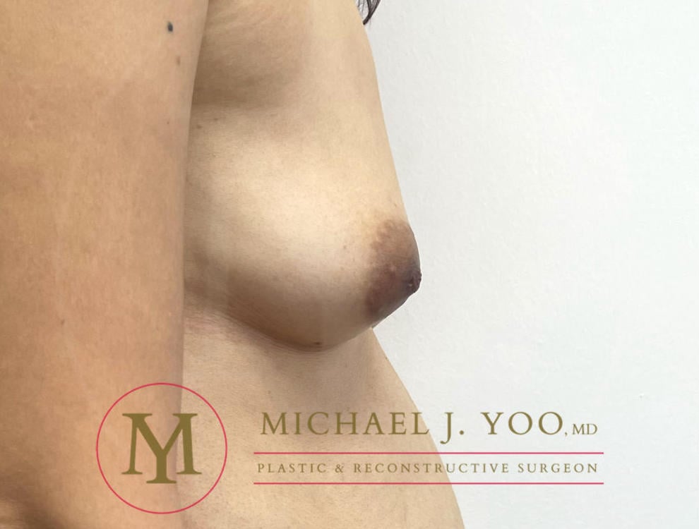 Nipple Reduction Before & After Patient #3838