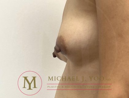Nipple Reduction Before & After Patient #3838