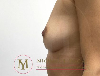 Nipple Reduction Before & After Patient #3829