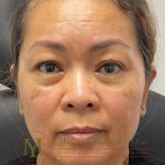 Upper Eyelid Lift Before & After Patient #3839