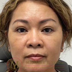 Upper Eyelid Lift Before & After Patient #3839