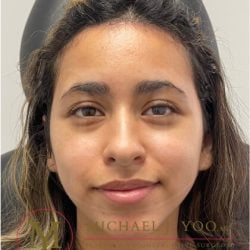 Forehead Reduction Before & After Patient #3869