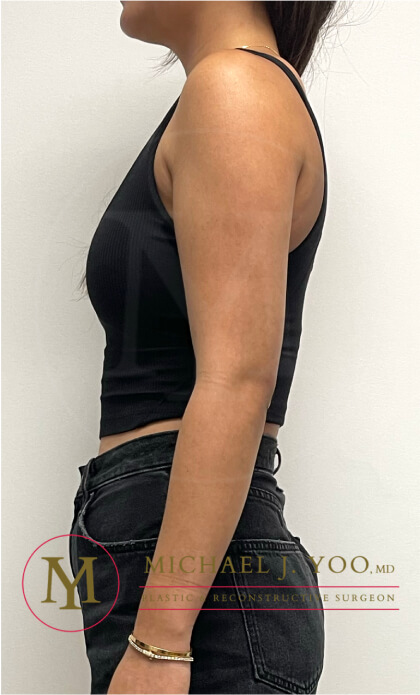 Arm Liposuction Before & After Patient #3862