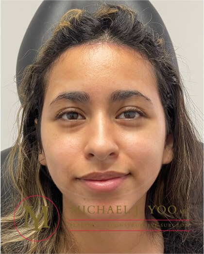 Forehead Reduction Before & After Patient #3869