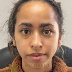 Forehead Reduction Before & After Patient #3869