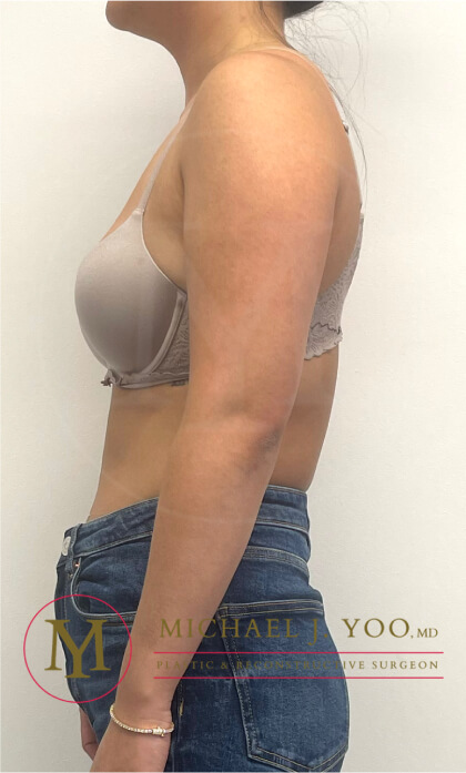 Arm Liposuction Before & After Patient #3862