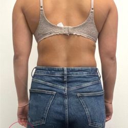 Arm Liposuction Before & After Patient #3862