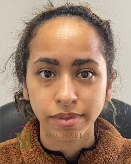 Forehead Reduction Before & After Patient #3869