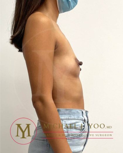 Breast Augmentation Before & After Patient #3846