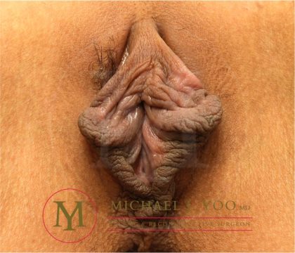 Labiaplasty Before & After Patient #3853