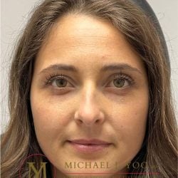 Lower Eyelid Lift Before & After Patient #3856