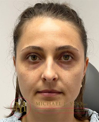 Lower Eyelid Lift Before & After Patient #3856