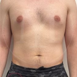 Areola Reduction Before & After Patient #3907