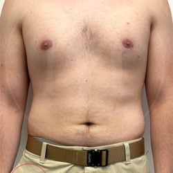 Areola Reduction Before & After Patient #3907