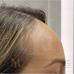 Forehead Reduction Before & After Patient #3943