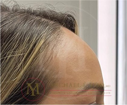 Forehead Reduction Before & After Patient #3943
