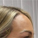 Forehead Reduction Before & After Patient #3943