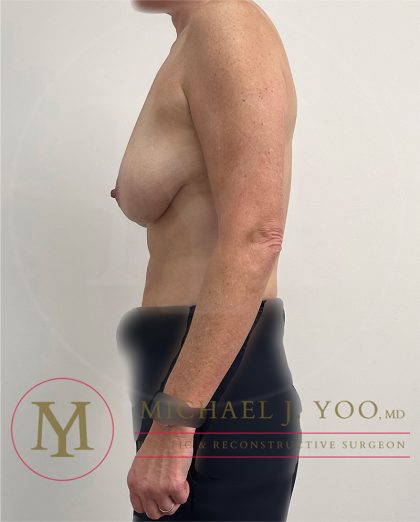 Breast Lift Before & After Patient #3946
