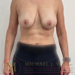 Breast Lift Before & After Patient #3946