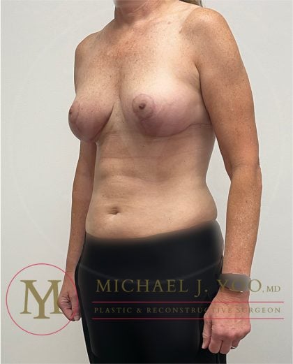 Breast Lift Before & After Patient #3946