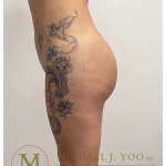 Liposuction Before & After Patient #3910