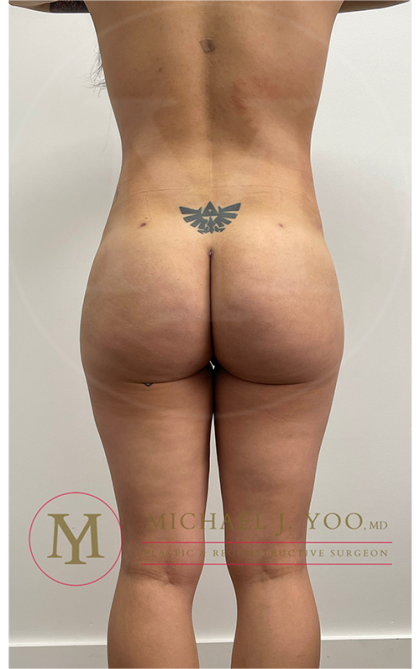 Liposuction Before & After Patient #3910
