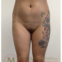 Liposuction Before & After Patient #3910