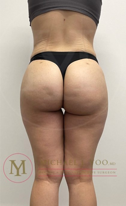 Liposuction Before & After Patient #3926