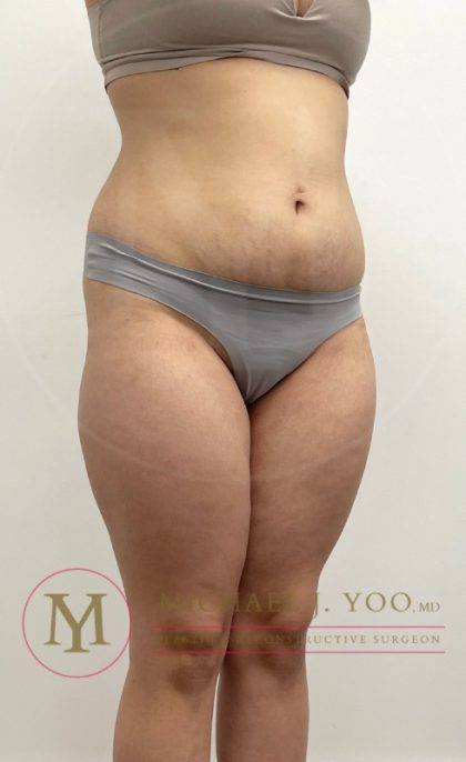 Liposuction Before & After Patient #3926