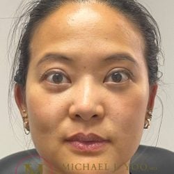 Lower Eyelid Lift Before & After Patient #3957