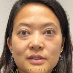 Lower Eyelid Lift Before & After Patient #3957