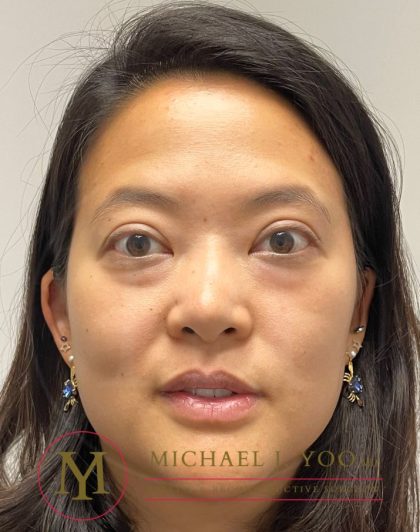 Lower Eyelid Lift Before & After Patient #3957