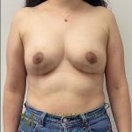 Areola Reduction Before & After Patient #4147